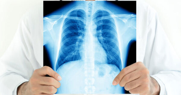 La tuberculosis y el rol crucial de la radiografía en su detección 