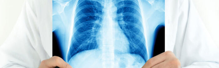La tuberculosis y el rol crucial de la radiografía en su detección 